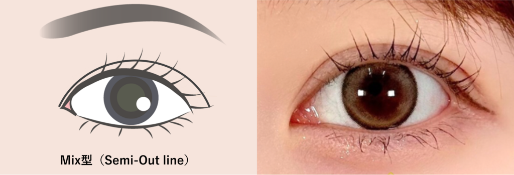 Mix型(ミックス型)二重、Semi-Out-line(セミアウトライン)とも呼ばれる