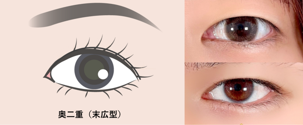 奥二重は末広型二重