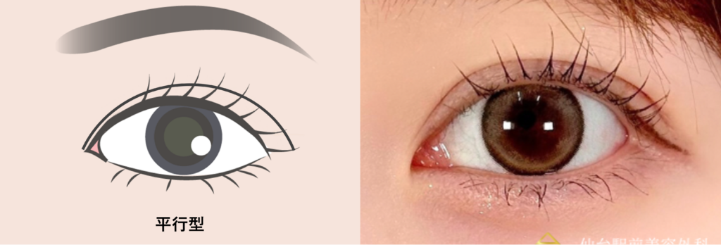 二重幅が目頭から末広がりになる平行型二重