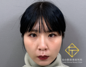 脂肪吸引注射（After）