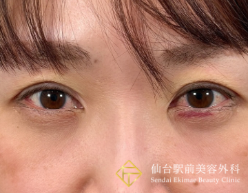 二重埋没法抜糸（After）