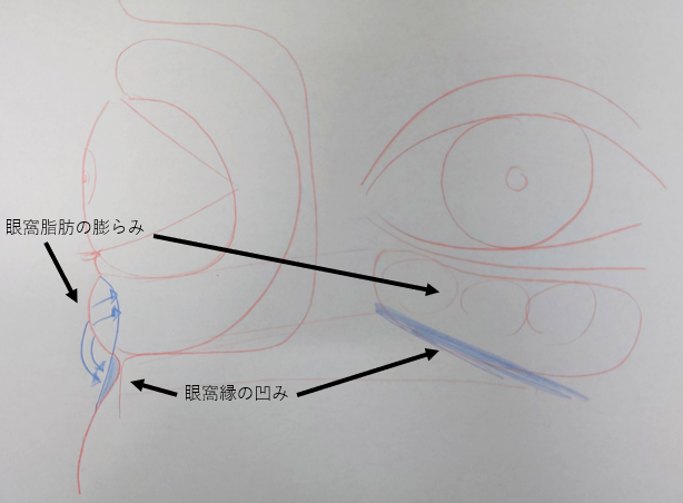 目の下のクマの前から見たところと横から見たところ