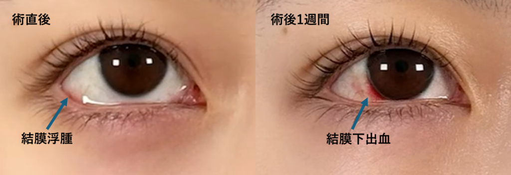 結膜浮腫と結膜下出血