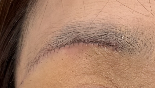 眉下切開の抜糸前のキズ