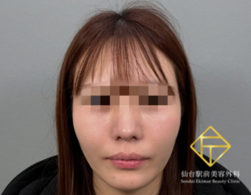 糸リフト・メーラーファット除去（After）