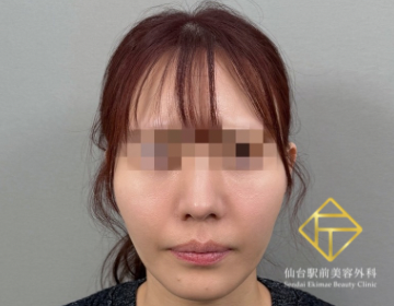 糸リフト・メーラーファット除去（Before）