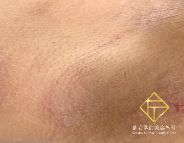 ワキガ治療(剪除法)（Before）