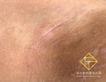 ワキガ治療(剪除法)（After）