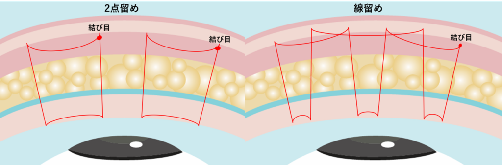 二重埋没法の点留めと線留め