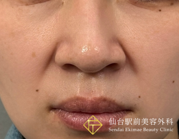 小鼻縮小(埋没法)（Before）