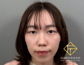 二重埋没法（Before）