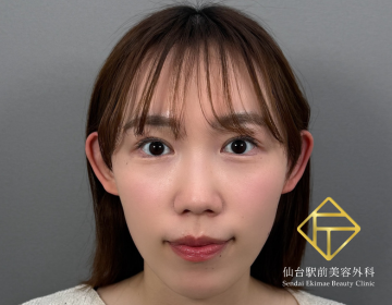 二重埋没法（After）