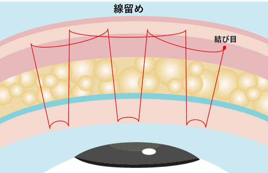 線留め埋没法
