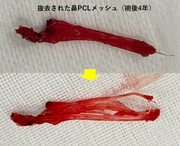 抜去されたPCLメッシュ