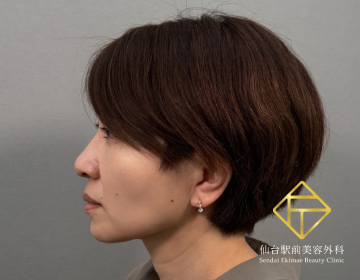 脂肪吸引(顎下)（After）