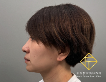 脂肪吸引(顎下)（Before）