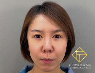 糸リフト（Before）